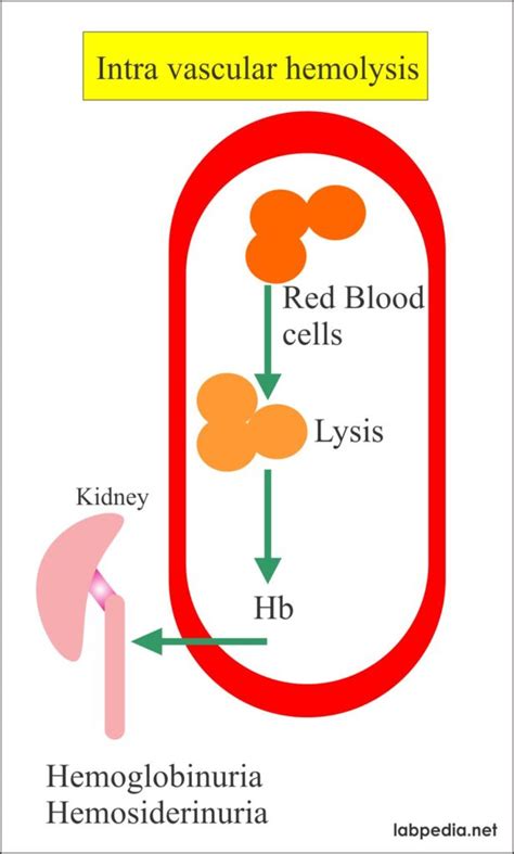 Anemia Part 6 Hemolytic Anemias Causes And Lab Diagnosis