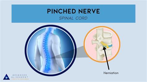 Pinched Nerve Chiropractic Treatment Is The Best Option