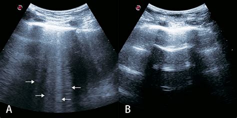 Role Of Lung Ultrasound In Adjusting Ultrafiltration Volume In