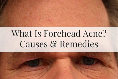 2 Types Of Forehead Acne Treatment That Are Effective 2023