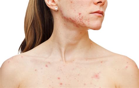 Acne The Most Common Skin Disease