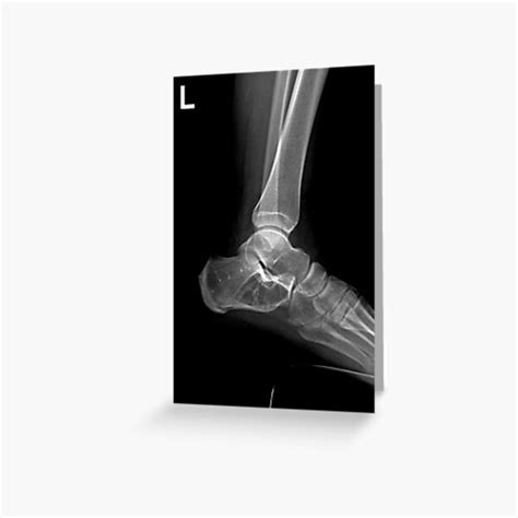 Ankle X Ray Greeting Card By Cornstalk Redbubble