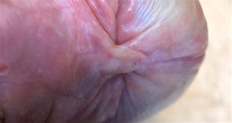 Liquen escleroso Tratar manchas blancas en el pene Urólogo Vigo