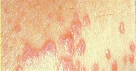 Diseased Skin Lichen Planus Lichen Planus Is A Fairly
