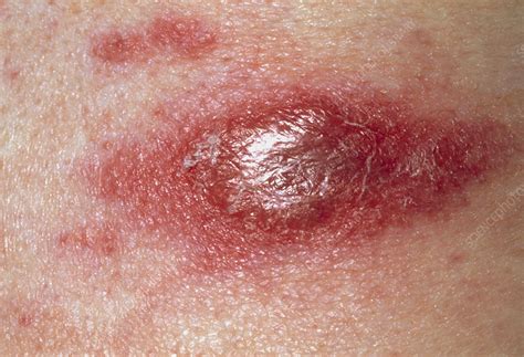 Cancerous Red Skin Lesion Due To T Cell Lymphoma Stock Image M131
