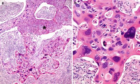 Squamous Cell Carcinoma Cervical Cancer