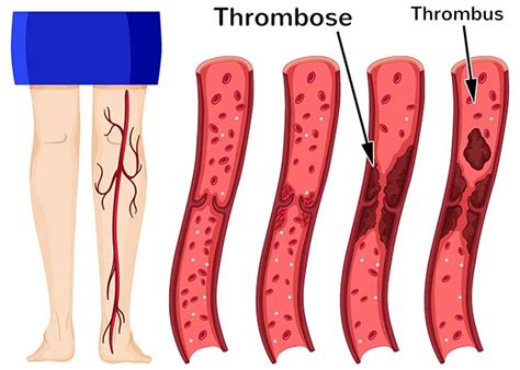 Thrombose — thrombōse (grch.), gerinnung des blutes innerhalb der lebenden blutgefäße und durch das blutgerinnsel (blutpfropf, thrombus) veranlaßte verstopfung derselben, entsteht nach verletzungen (traumatische t.) und kompression (kompressions t.) der… … Thrombose