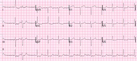 Dr Smiths Ecg Blog Chest Pain And Cardiogenic Shock With Profound St