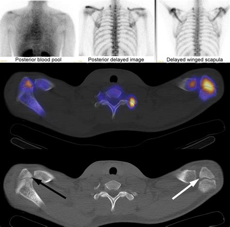 Use Of Spectct With 99mtc Mdp Bone Scintigraphy To Diagnose