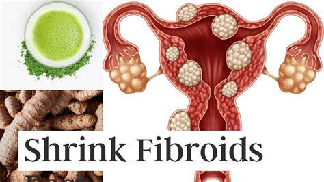 Ways To Shrink Fibroids Naturally Without Surgery Youtube