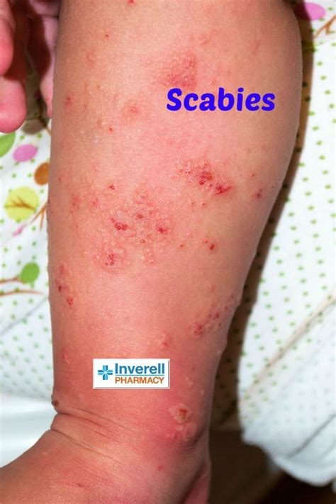 How To Identify Scabies On Face Biayaku