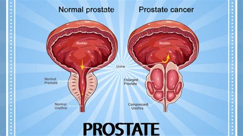 Bph Prostate Enlargement Superior Pharmacy Inc