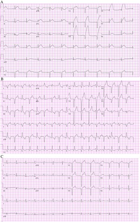 Bidirectional Fascicular Tachycardia With Alternating Axis Deviation