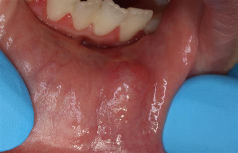 Oral Mucocele Internetodontologi