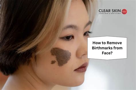 How To Remove Birthmarks From Face