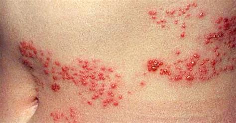 Is It Shingles 7 Myths About Painful Illness Graphic Images Cbs News