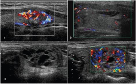 Patterns Of Vascularity In Thyroid Nodules The Nodule In A With