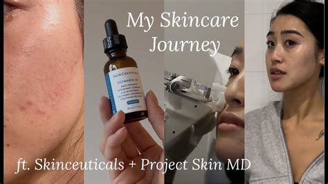 My Skin Journey Dealing With Hormonal Acne Congestion And Texture Ft