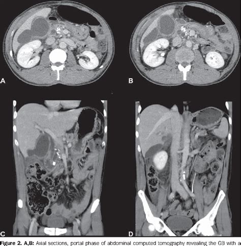 Figure 2 From Spontaneous Perforation Of Gallbladder With Intrahepatic