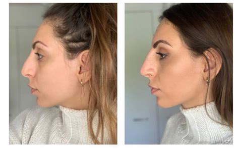 Hook Nose Before And After Before And After Photo Of A 24 Year Old Female Patient Who Had