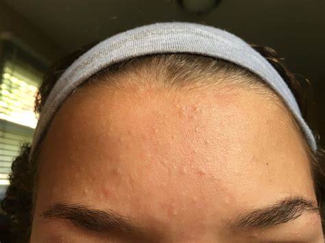 Small Colorless Spots All Over Forehead Visible Pores No