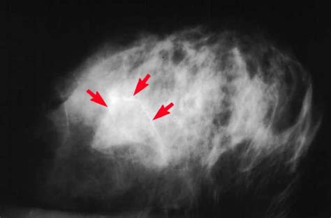 What Breast Calcifications Mean On Your Mammogram