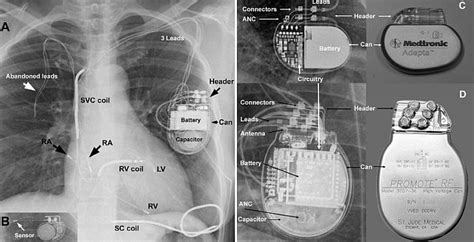 Advances in technology have reduced the chances that machines, such as microwaves, could interfere with your device. Which Pacemaker/ICD is that Again