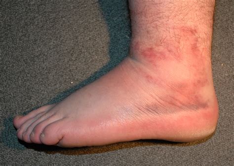 Left Ankle Bruising This Makes It Twice In 3 Months I T Flickr
