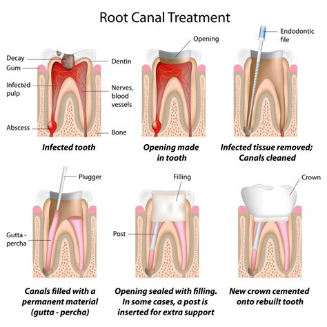 Root Canal Procedure Southlake Endodontics