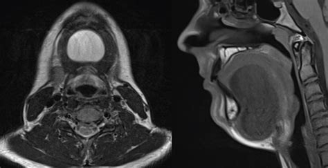 Management Of A Large Sublingual Dermoid Cyst