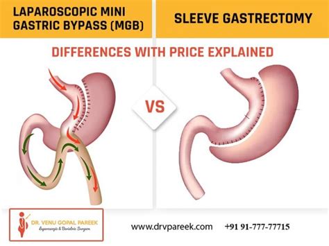 Laparoscopic Mini Gastric Bypass Mgb Vs Sleeve Gastrectomy Differences With Price Explained