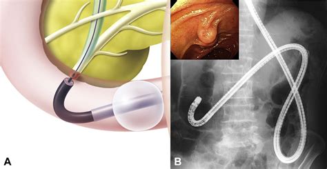 Balloon Enteroscopyassisted Ercp In Patients With Roux En Y