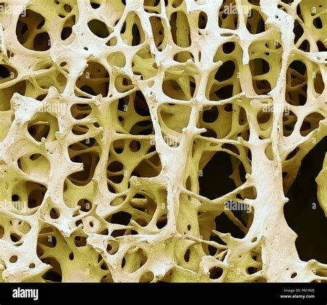 Bone Tissue Coloured Scanning Electron Micrograph Sem Of Human