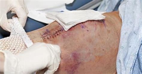Check spelling or type a new query. Knee Replacement Scars | LIVESTRONG.COM