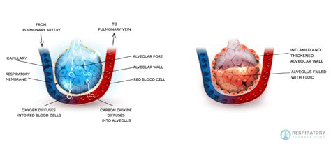 Pulmonary Edema Vs Pneumonia An Overview 2023