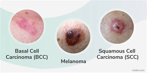 Describe The Three Types Of Skin Cancer CancerWalls