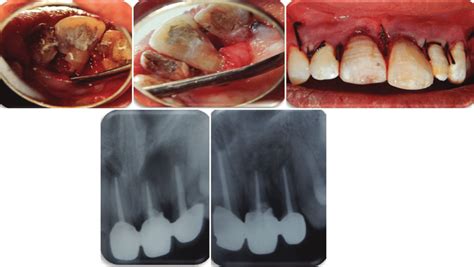 A Palatal Flap Raised Showing Palatal Defect B Sealed Defect Using