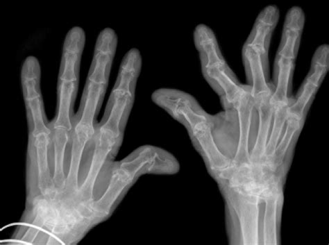 Rheumatoid arthritis manifests as a symmetrical arthritis, most commonly affecting the hands. New wind in the sails of rheumatoid arthritis research ...