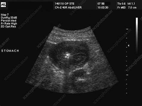Stomach Cancer Ultrasound Stock Image M1340414 Science Photo