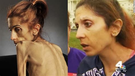 anorexic woman who weighed only 40 pounds makes dramatic transformation fox8 wghp