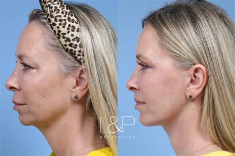 Before And After Photos Of Chin Augmentation At Landp Aesthetics In Palo