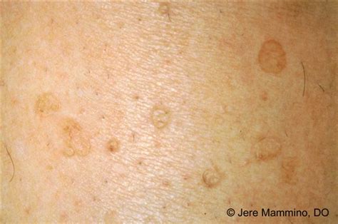 Disseminated Superficial Actinic Porokeratosis American Osteopathic