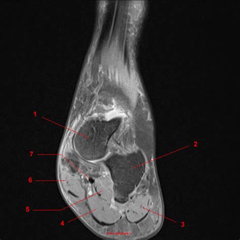 The presence of intramuscular edema (increased high t2/stir signal) on mri carries an extremely broad differential. Risonanza magnetica della caviglia: anatomia dettagliata