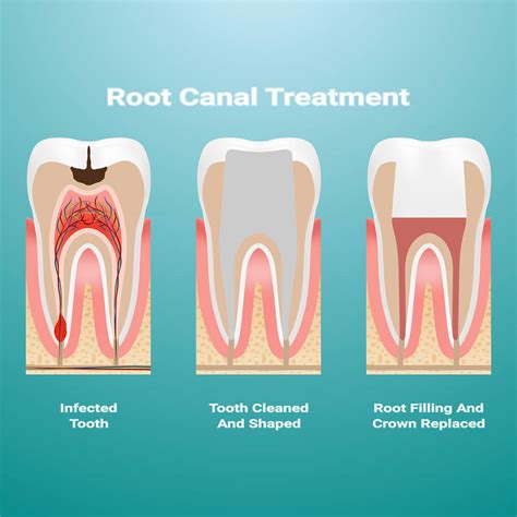 Root Canal Therapy Dallas Barry H Buchanan Dds