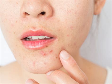 For The Acne Prone Face Masks May Mean Breakouts News Uab