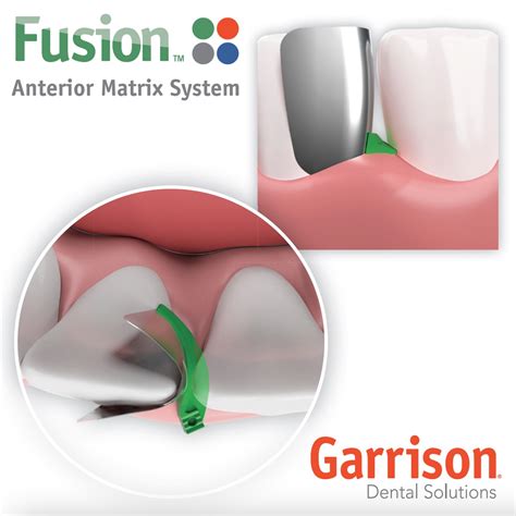 Garrison Releases Fusion Anterior Matrix System Dental Industry News Dentaltown