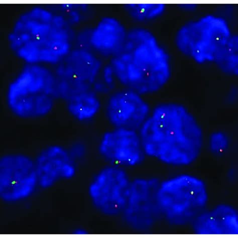 Granular Cytoplasmic Staining Of The Anaplastic Lymphoma Kinase Alk