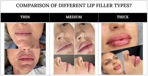 thin medium and thick lip filler what s the difference mapp injectables