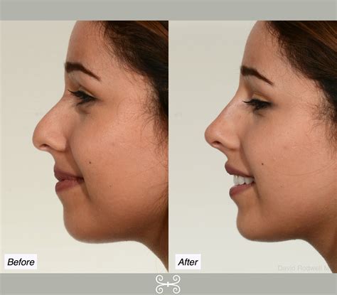 Our system stores nose job photo. non surgical nose job - Charleston Facial Plastic Surgery
