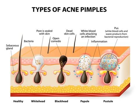 Types Of Spots Pimples